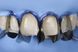 Unica anterior набір - універсальна система матриць для передніх зубів, вінірів 6900 фото 3