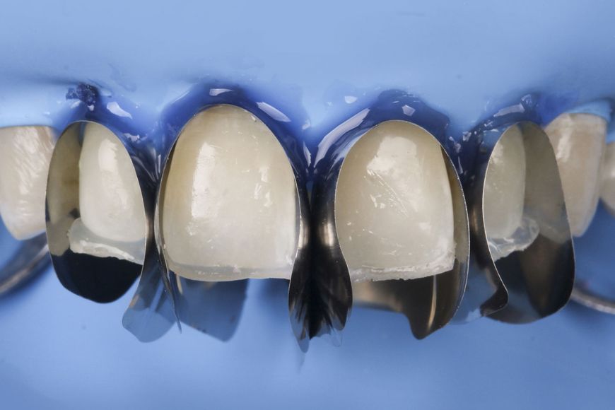 Unica anterior набір - універсальна система матриць для передніх зубів, вінірів 6900 фото